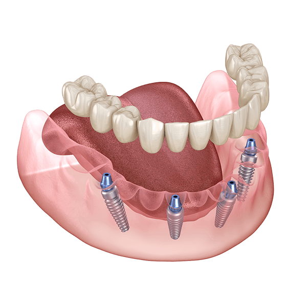 X-ray view showing dental implant placement