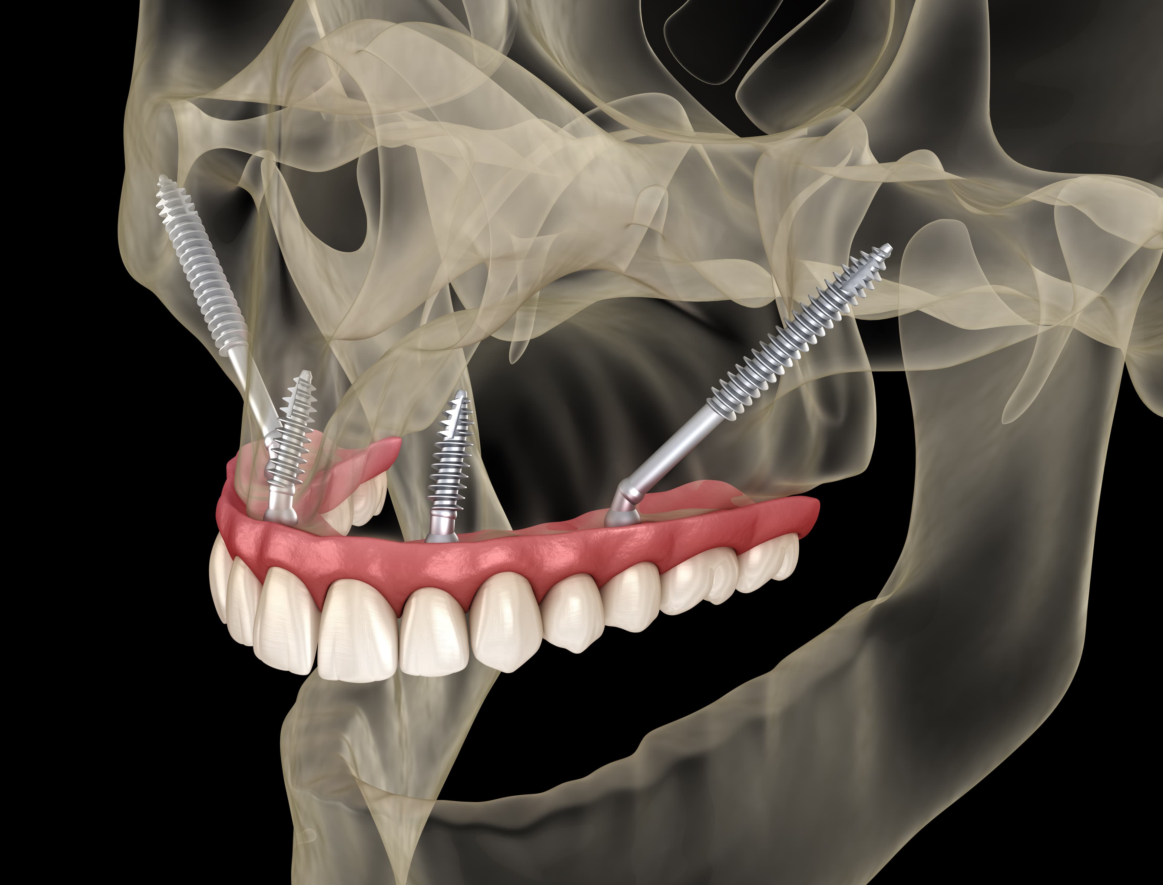 Dental implant model showing four implants supporting a full arch